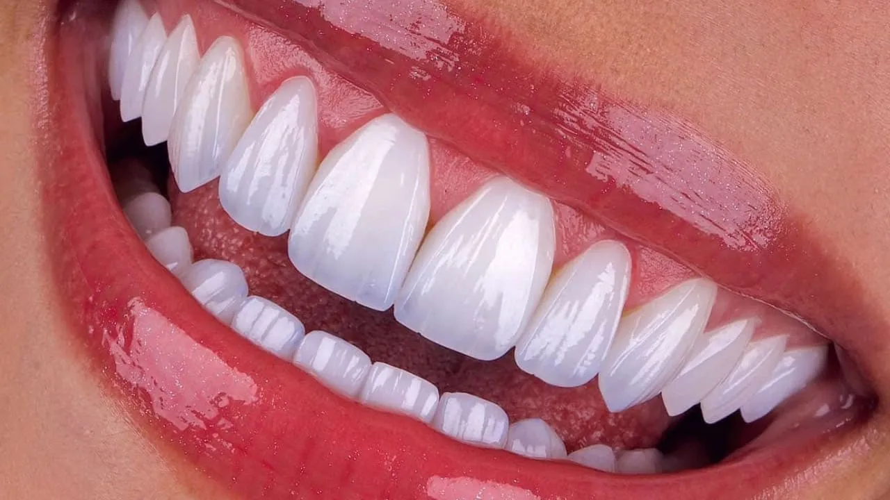 Ultra Aesthetic Veneers