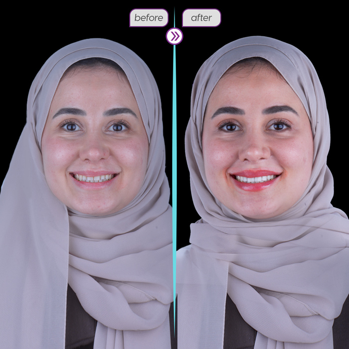 Smile case